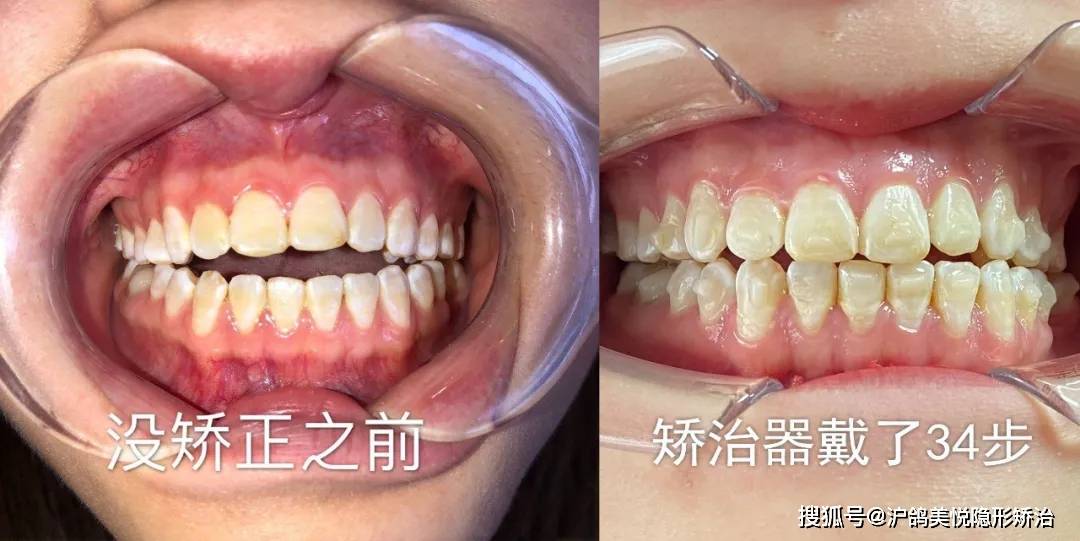 哔哩哔哩如何变成小会员？轻松解锁高级体验！